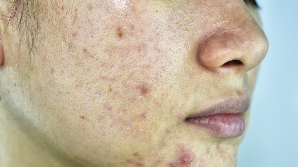skincare mistakes causing acne