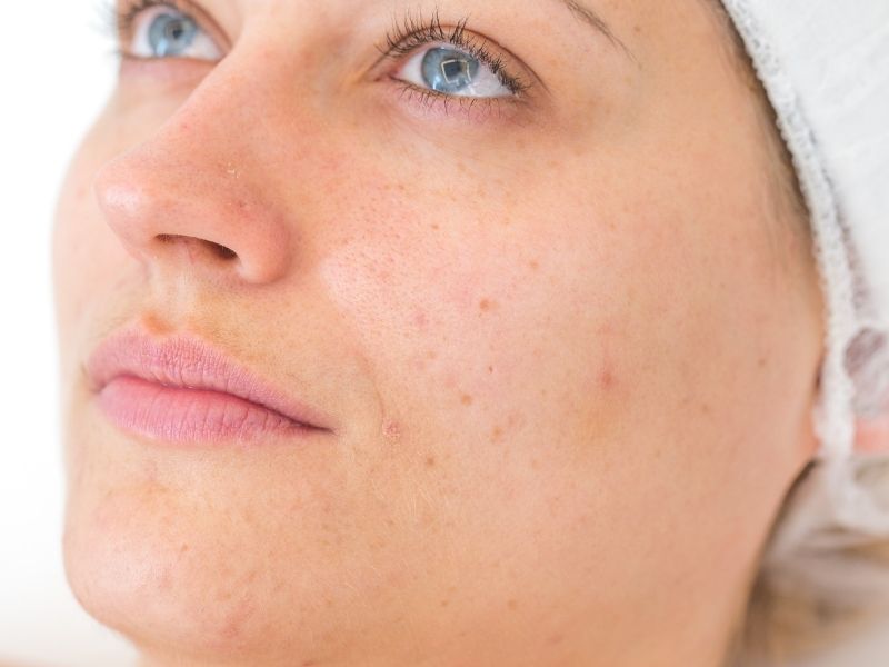 woman with acne